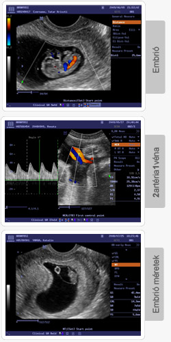 Embrió ultrahang felvételek
