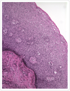 A condyloma húgycsövében Rák malignus hemopátia